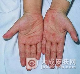手足口病主要引发因素是什么