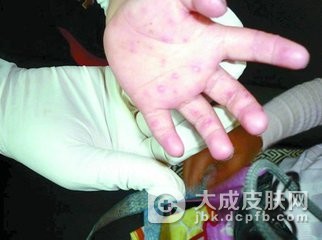 导致手足口病发生的原因有哪些