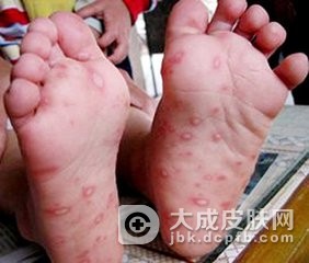 患手足口病怎么办