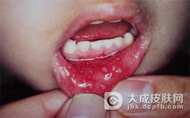 儿童出现手足口病要尽快治疗