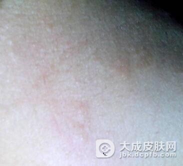 蔬菜也会引发日光性皮炎吗