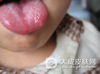 手足口病主要的症状体现在哪