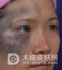 太田痣的常见症状具体有哪些