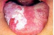 口腔白斑病的病因会是什么