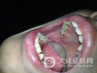 得了口腔白斑怎么的治疗