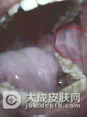 口腔白斑病有什么样的类型