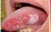口腔白斑有哪些的临床表现