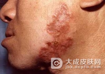 寻常狼疮的并发症有什么