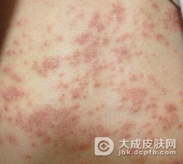 急性湿疹患者不能食用什么呢