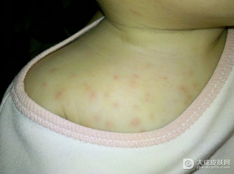 生活中急性湿疹的常见症状