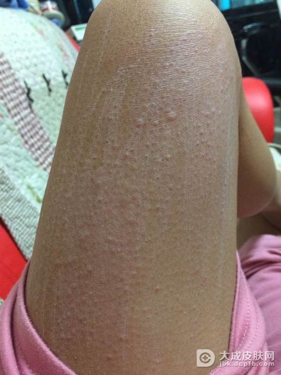 怎样治疗急性荨麻疹