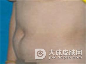 得了脂肪瘤饮食注意什么
