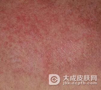 皮肌炎的食疗方法