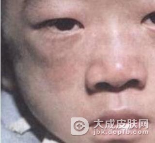患有皮肌炎的主要病因有哪些呢