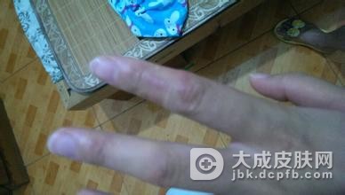 如何正确调理多形红斑呢