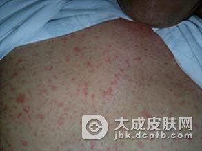 固定性药疹怎么治疗好呢