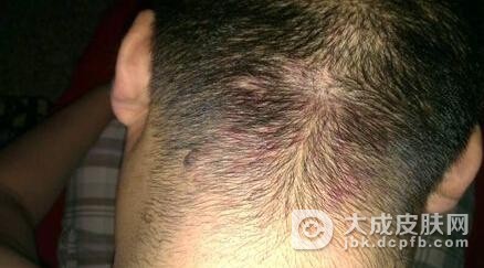 哪些是脱发性毛囊炎的病因
