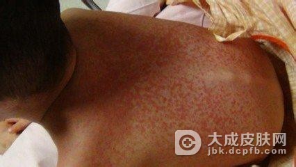 硬肿症有哪些发病特点呢