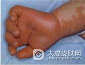 成人硬肿症的临床特点是什么呢