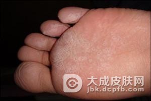 儿童脚部角化型脚气的发病特征