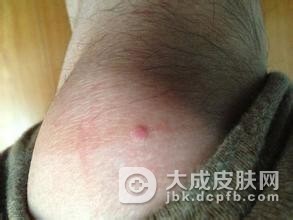 怎么有效治疗寻常疣
