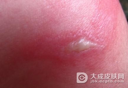 脓疱疮这种病有什么特点