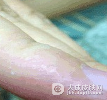 汗疱疹是怎么一回事啊
