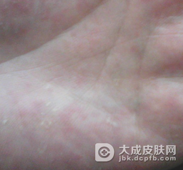 汗疱疹需要怎样的预防才好呢
