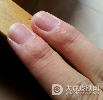 手癣患者生活中注意什么呢