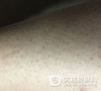 鱼鳞病的患者的生活细节注意