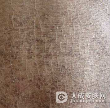 防治鱼鳞病患者要注意哪些问题
