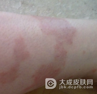 导致牛皮癣病情加重的原因是什么