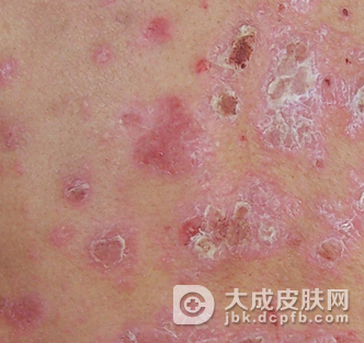 牛皮癣患者忌吃生鸡蛋