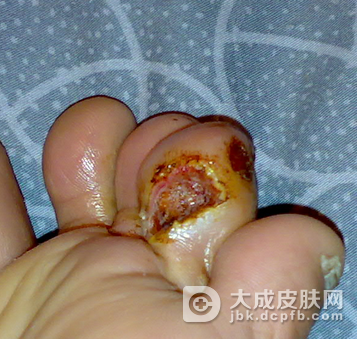 生活中怎样预防脚鸡眼呢