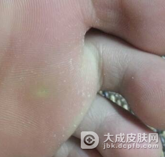 预防鸡眼选鞋很重要