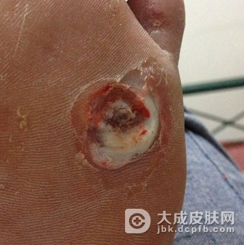 鸡眼有没有传染性