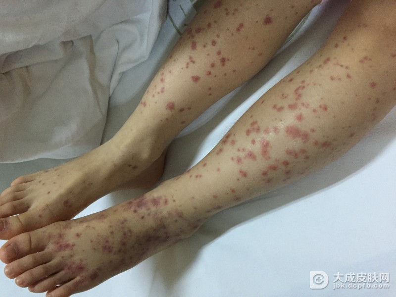 过敏性紫癜传染吗
