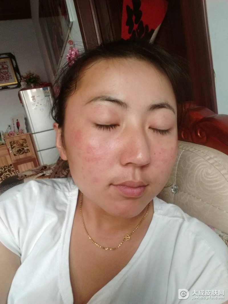 皮肤过敏怎么处理呢
