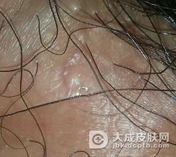 治疗一期梅毒应该怎样做