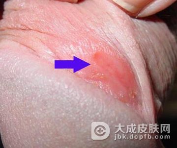 一期梅毒发病有什么迹象
