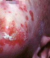什么是肠病性肢端皮炎