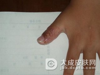 肠病性肢端皮炎诊断方法