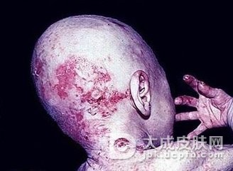 肠病性肢端皮炎的胃部损害