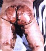 肠病性肢端皮炎的典型皮肤症状