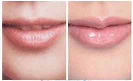 剥脱性唇炎的三大治疗原则是什么