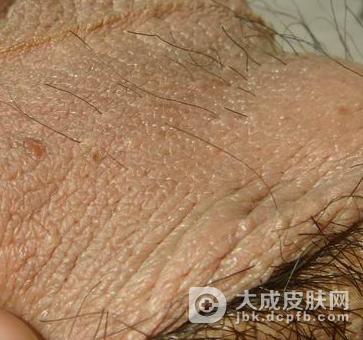 阴囊湿疹日常生活中的注意事项