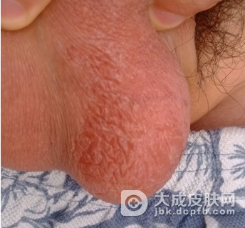诱发阴囊湿疹的常见病因有哪些呢