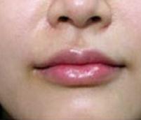 剥脱性唇炎并发症及急性过敏性唇炎的病因