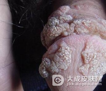 治愈尖锐湿疣从哪些方面做起呢