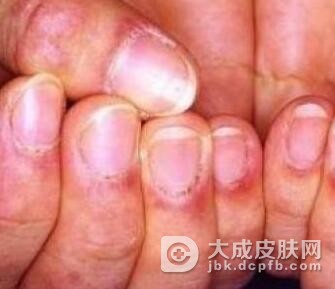 皮肌炎得病的原因是什么呢